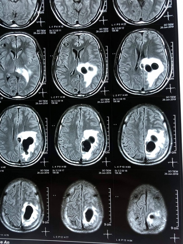 chụp CT não trong có tác dụng gì?