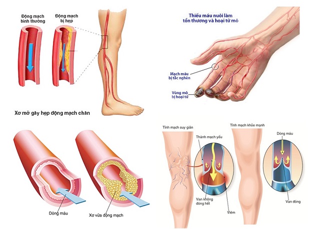 Bệnh mạch máu ngoại vi là gì