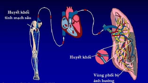 biến chứng do huyết khối tĩnh mạch gây ra