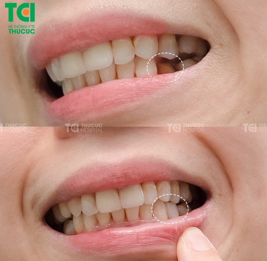 Bọc sứ chữa sâu răng giúp bệnh nhân bảo vệ được răng cũ khỏi các tác nhân gây sâu răng