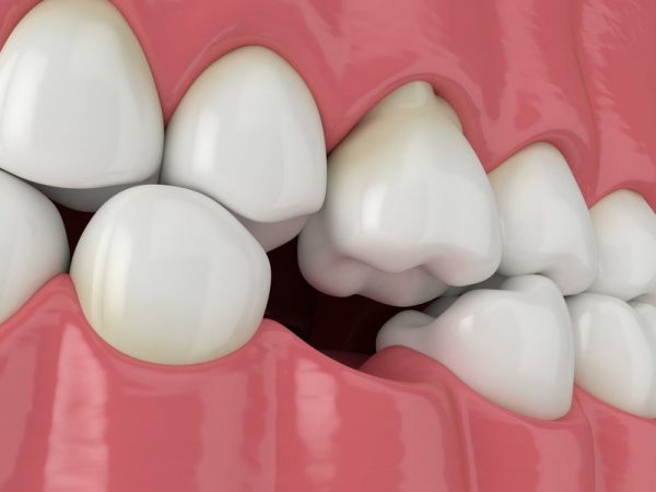Mất răng hàm ảnh hưởng lớn tới sức khỏe răng miệng cũng như thẩm mỹ khuôn mặt