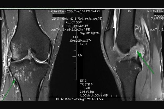 Chỉ định chụp cộng hưởng từ MRI trong chẩn đoán các bệnh về xương khớp