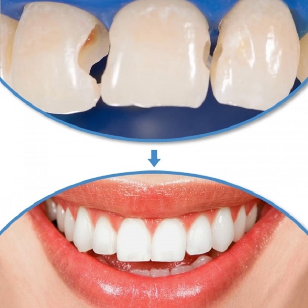 Hình ảnh trước và sau hàn răng là lời giải đáp thuyết phục cho câu hỏi