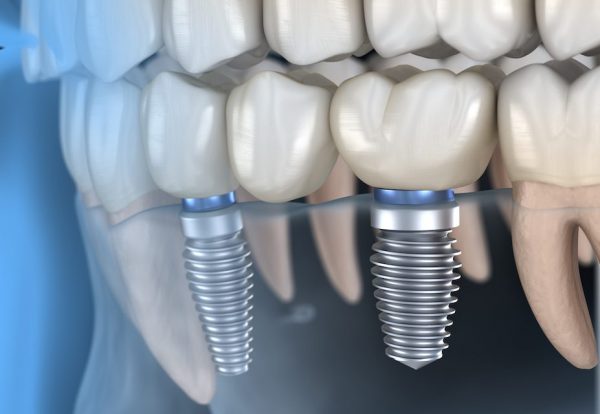 Trồng răng sứ chính là giải pháp hiệu quả giúp khắc phục mọi khiếm khuyết do răng bị mất gây ra