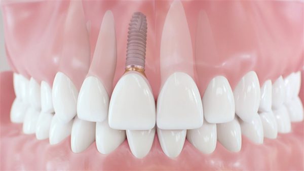 Trồng răng là kỹ thuật bổ sung răng vào vị trí răng đã mất bằng công nghệ hiện đại