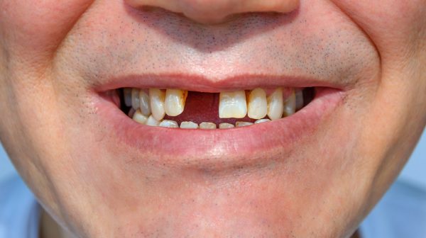 Răng cửa bị mất ảnh hưởng lớn tới sức khoẻ răng miệng, khiến mọi người cảm thấy tự ti khi giao tiếp.