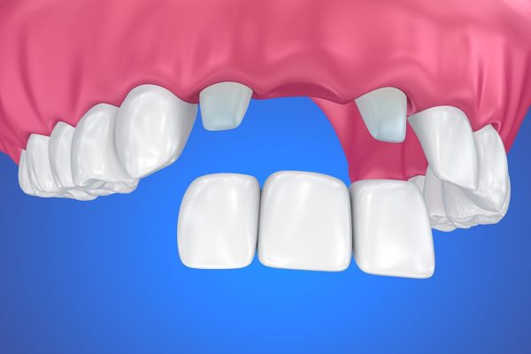 4. Giá trồng răng cửa cao bao nhiêu hiện nay? Giá trồng răng cửa hiện nay có thể dao động từ vài trăm nghìn cho tới vài chục triệu đồng/răng. Phương pháp thực hiện là yếu tố chính quyết định sự chênh lệch rõ rệt về chi phí đến như vậy. Với phương pháp dùng hàm giả tháo lắp, mọi người chỉ cần chi trả mức phí khoảng vài trăm nghìn đồng. Trong khi đó, một chiếc răng Implant có thể có mức giá lên tới hàng chục triệu đồng tùy chất liệu. Bên cạnh đó, tình trạng sức khỏe răng miệng cũng sẽ quyết định một phần chi phí người bệnh phải bỏ ra khi muốn trồng răng cửa. Nếu mắc bệnh lý răng miệng, bác sĩ sẽ chỉ định điều trị bệnh lý trước khi tiến hành trồng răng để đạt hiệu quả phục hình nha khoa cao nhất. Mức giá trồng răng ở các cơ sở nha khoa có thể khác nhau do trình độ chuyên môn, tay nghề của bác sĩ cũng như trang thiết bị y tế thực hiện thủ thuật trồng răng. Trồng răng là kỹ thuật khó, đòi hỏi bác sĩ phải có chuyên môn sâu dày, kết hợp máy móc hiện đại, tiên tiến. Do đó, việc lựa chọn cơ sở nha khoa uy tín để trồng răng là cách tốt nhất giúp bạn đảm bảo an toàn, hiệu quả cũng như chí phí bản thân phải bỏ ra để sở hữu hàm răng hoàn hảo, nụ cười tự tin. Như vậy, xét trên nhiều yếu tố thì giá trồng răng cửa có thể dao động từ hàng trăm tới hàng chục triệu đồng. Bạn nên liên hệ trực tiếp với các nha khoa uy tín để được bác sĩ có chuyên môn thăm khám, tư vấn phương pháp trồng răng phù hợp để tiết kiệm chi phí tối đa.