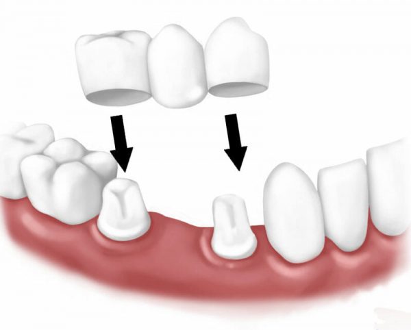 Bắc cầu răng sứ là một trong những phương pháp trồng răng hiện đại mang lại hiệu quả vượt trội trong việc phục hình nha khoa