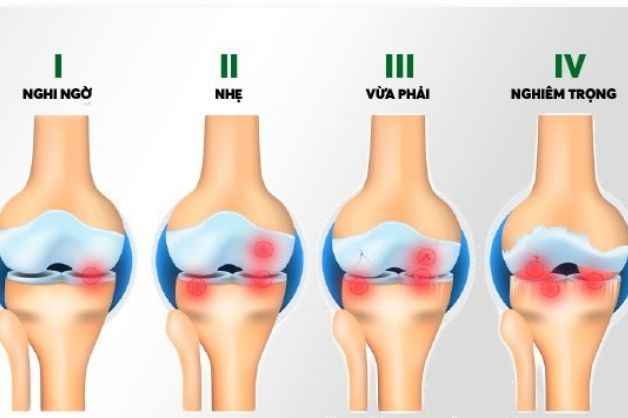 Thoái hóa khớp gối m17 tiến triển qua 4 giai đoạn