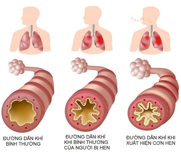 hen phế quản ở trẻ