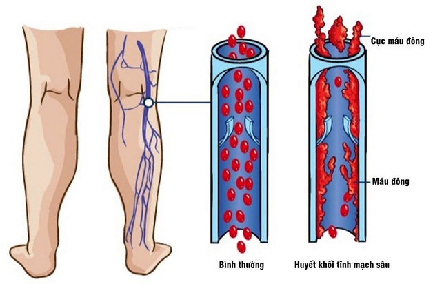 huyết khối tĩnh mạch sâu là gì?
