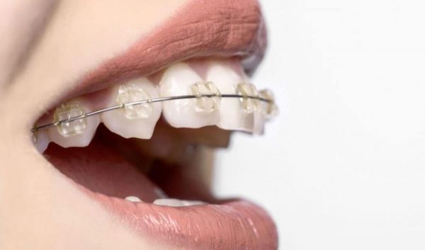 Có rất nhiều phương pháp chỉnh nha hiện đại được áp dụng để niềng 1 hàm hiện nay