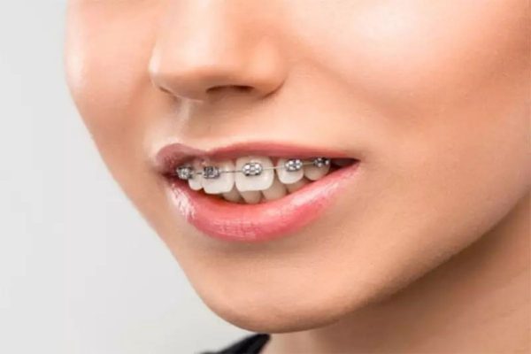 Niềng răng là thủ thuật chỉnh nha giúp điều chỉnh vị trí răng trên cung hàm bằng khí cụ chuyên dụng