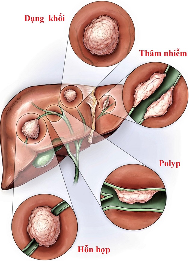 các phương pháp phẫu thuật ung thư đường mật