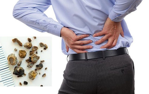 triệu chứng sỏi niệu quản ⅓ trên