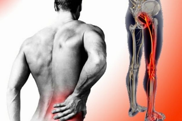 đau dây thần kinh tọa là gì