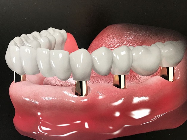 Trồng răng không chỉ là phương pháp tái tạo thẩm mỹ mà còn phục hồi hiệu quả chức năng ăn nhai