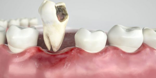 Bệnh lý hoặc chấn thương có thể khiến răng hàm bị mất hoặc phải nhổ bỏ