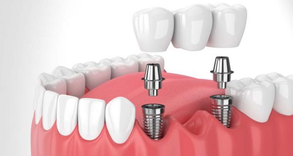 Có rất nhiều phương pháp trồng răng được áp dụng để khắc phục tình trạng răng hàm bị mất hiện nay