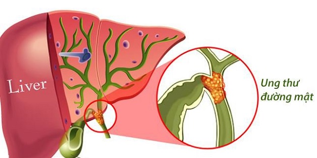 Phẫu thuật ung thư đường mật 