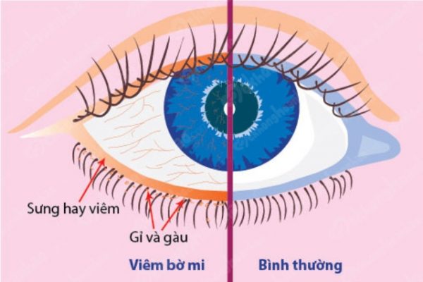 viêm bờ mi