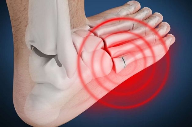 Viêm khớp bàn chân gây đau đớn khi di chuyển