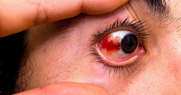 bệnh lý hắc võng mạc trung tâm thanh dịch