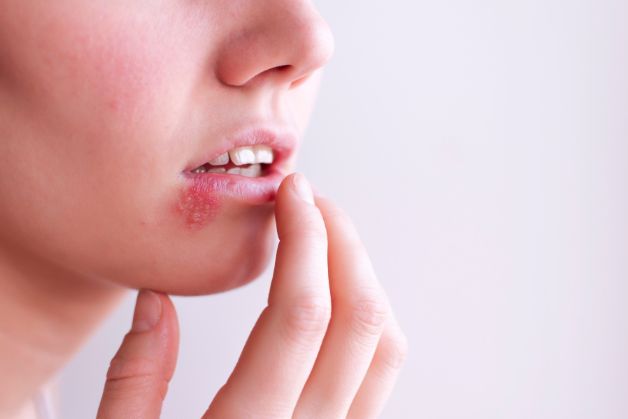 Điều trị bằng thuốc theo chỉ định của bác sĩ có thể làm giảm các triệu chứng và rút ngắn thời gian mắc bệnh herpes ở môi