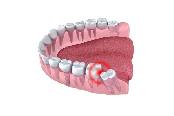 Răng khôn mọc ngầm, mọc lệch có thể ảnh hưởng nghiêm trọng tới sức khỏe răng miệng nên cần phải nhổ bỏ