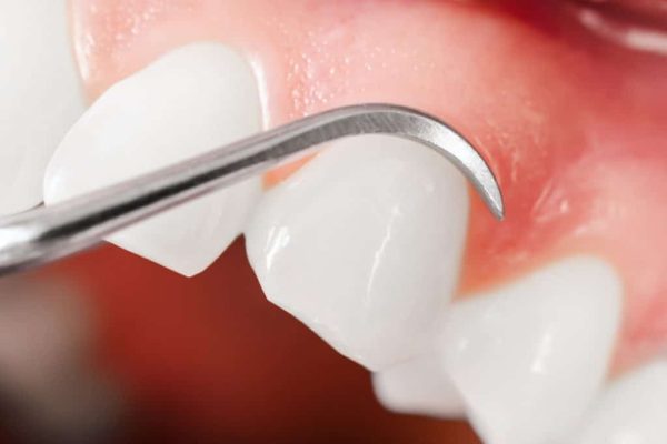 chữa viêm chân răng có mủ tại nhà