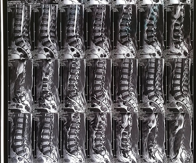 chụp mri cho vùng cột sống