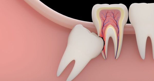 Theo các bác sĩ nha khoa TCI, răng không được chỉ định nhổ trong các trường hợp gây đau đớn và bệnh lý răng miệng...