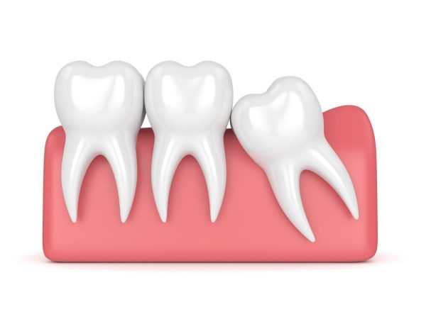 Có bao nhiêu răng số 8? - Người trưởng thành có tổng cộng 4 chiếc răng khôn mọc ở hai phía trên cả hai cung hàm
