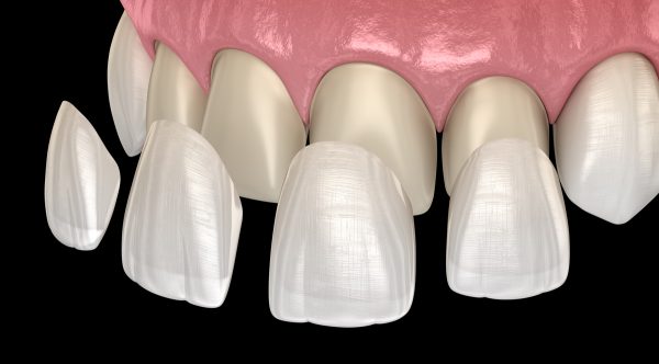 Dán sứ veneer là gì? Là kỹ thuật phục hình thẩm mỹ nha khoa hiện đại ít xâm lấn, mải răng được ưa chuộng hiện nay