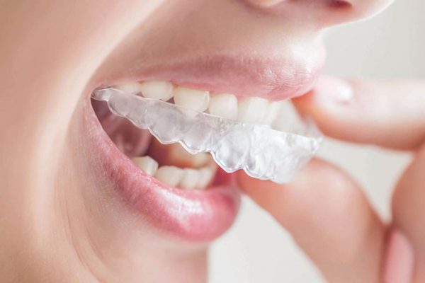 Khay niềng trong suốt có tính thẩm mỹ, ôm sát cung răng để điều chỉnh răng một cách an toàn