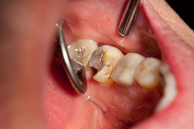Sâu răng là tình trạng phần mô cứng của răng bị tổn thương bởi quá trình hủy khoảng do vi khuẩn ở mảng bám gây ra