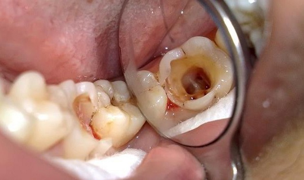 Các giai đoạn sâu răng dù là nặng hay nhẹ đều xuất phát từ các nguyên nhân vi khuẩn ăn mòn cấu trúc của răng.