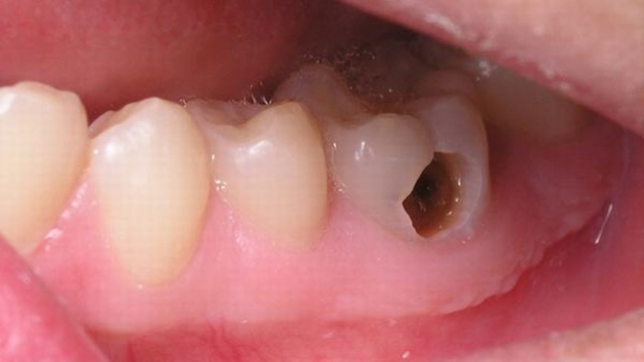 Răng số 8 bị sâu vỡ: Nguyên nhân và cách điều trị dứt điểm