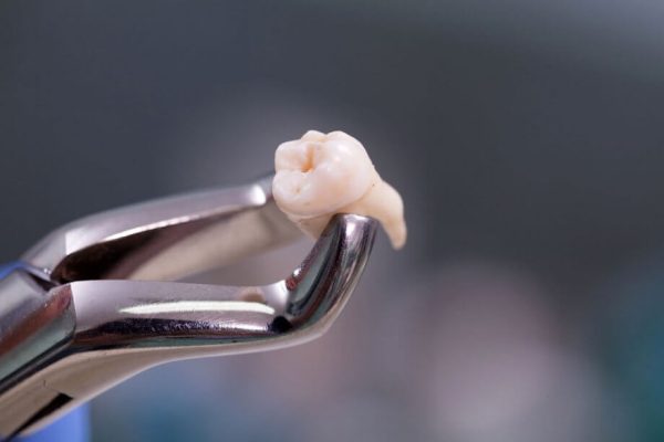 Phương pháp nhổ răng bằng kìm thông qua tác động lực làm gãy chân răng và lấy răng ra khỏi ổ xương hàm