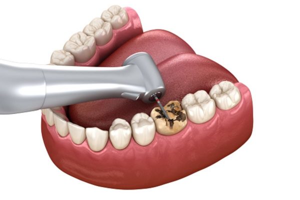 Sâu răng có niềng răng được không là một trong những thắc mắc bác sĩ nha khoa thường gặp trong quá trình thăm khám và điều trị