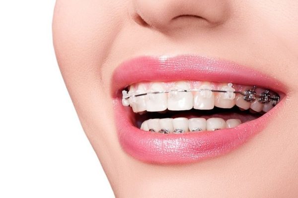 Khí cụ sẽ tác dụng lực theo từng mức độ lên răng, di chuyển vị trí của răng trong một khoảng thời gian nhất định