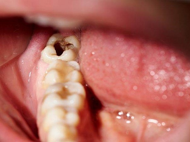 Sâu răng không phát triển cùng một lúc mà chia thành nhiều giai đoạn khác nhau