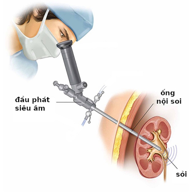 Bác sĩ sẽ dùng sức mạnh của laser để phá tan sỏi