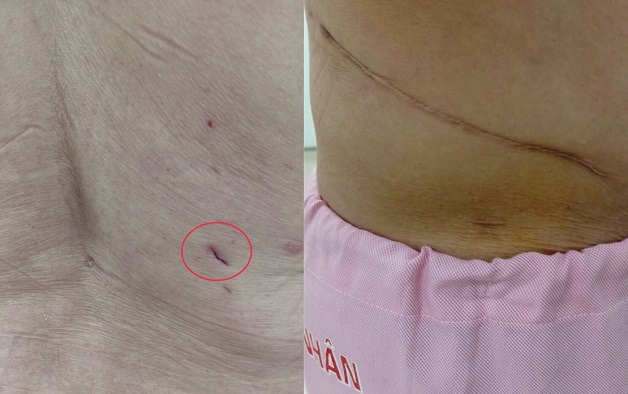 Sẹo khi thực hiện thủ thuật này sẽ nhỏ hơn rất nhiều so với mổ truyền thống