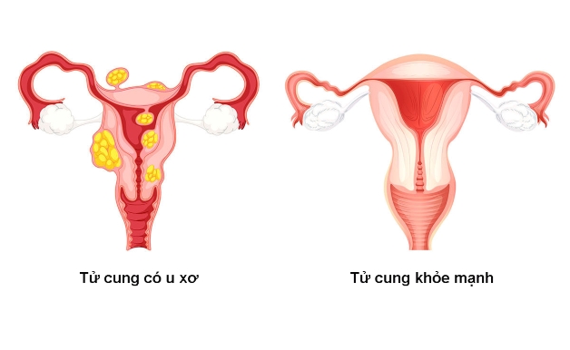 u xơ tử cung là bệnh lý phổ biến