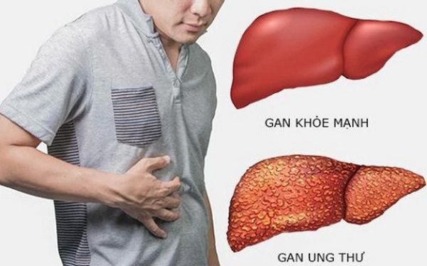 biểu hiện của bệnh ung thư gan thể thứ phát