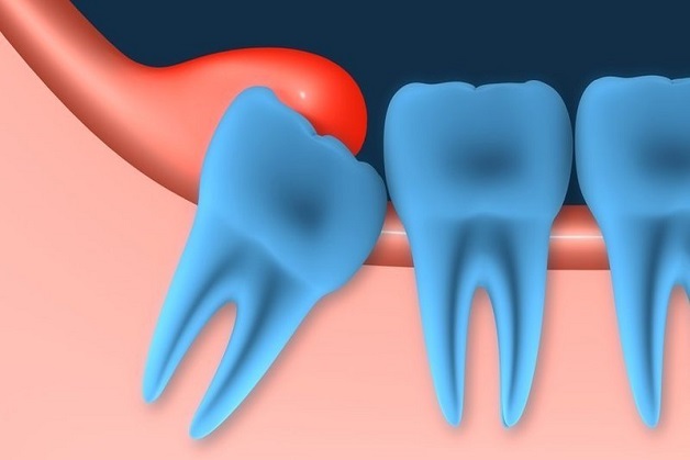 Tình trạng viêm lợi trùm răng khôn thường xảy ra phổ biến với răng khôn hàm dưới.