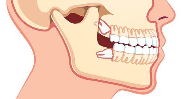 Viêm lợi trùm có thể xuất phát từ vị trí cũng như hướng mọc răng khôn
