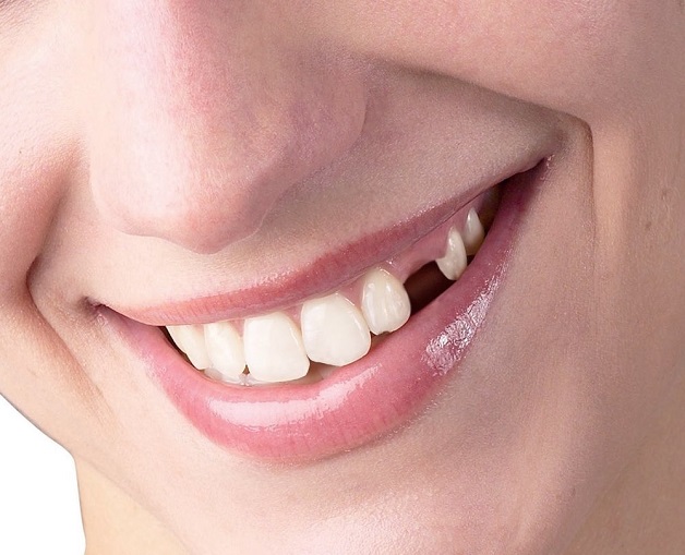 Với thắc mắc viêm nướu răng có nguy hiểm không, nếu như không được điều trị, viêm nướu có thể dẫn đến bệnh viêm nha chu, nguy cơ mất răng