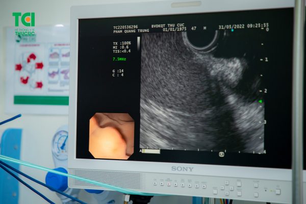 Hình ảnh siêu âm nội soi